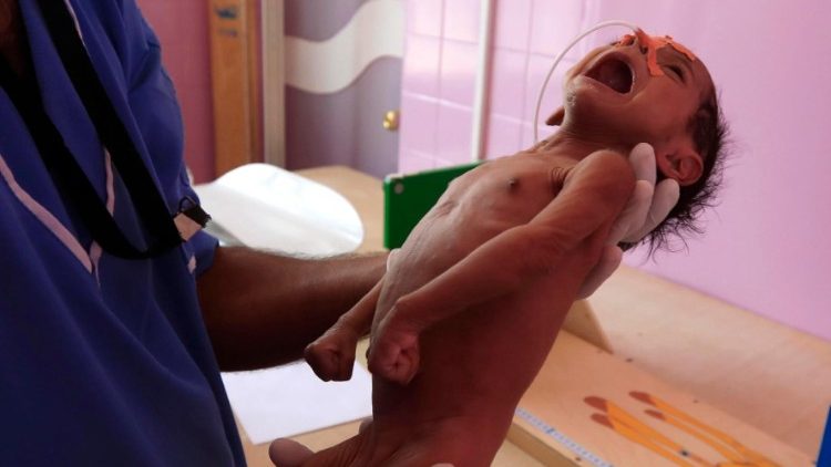 ஊட்டச்சத்து குறைபாட்டால் பாதிக்கப்பட்ட ஏமன் குழந்தை 