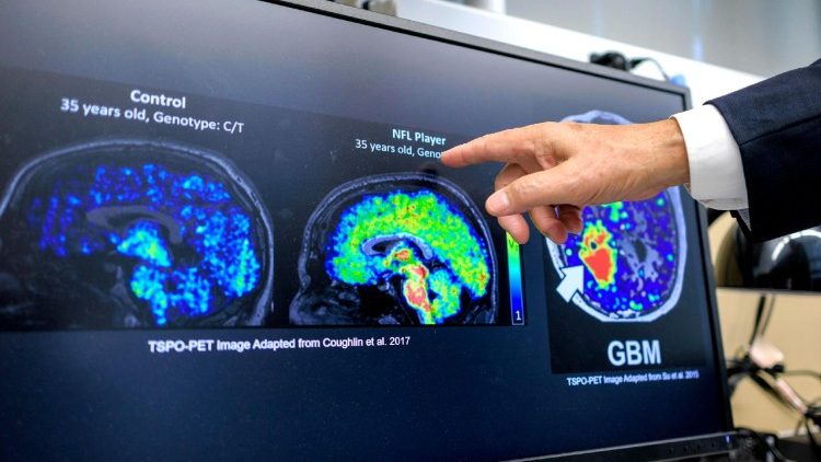 Una immagine del cervello in diverse condizioni legate alle malattie neurodegenerative