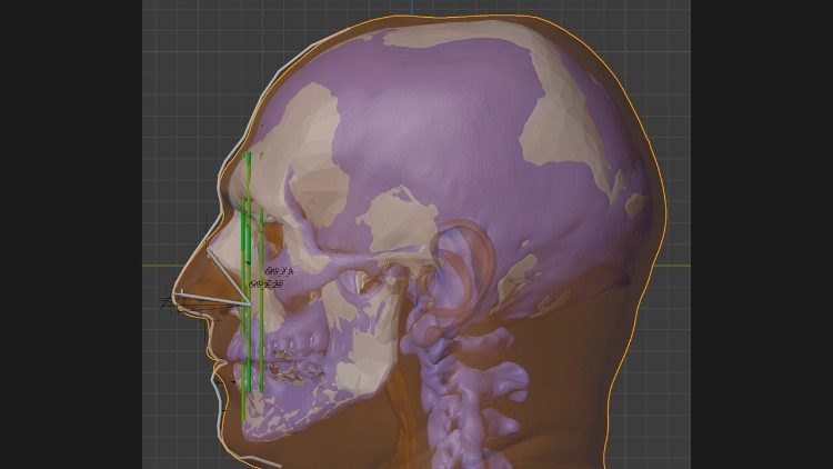 Uma das etapas da reconstrução facial de São Tomás de Aquino